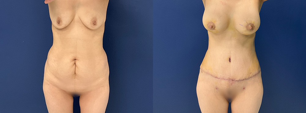 Mommy Makeover Before and After