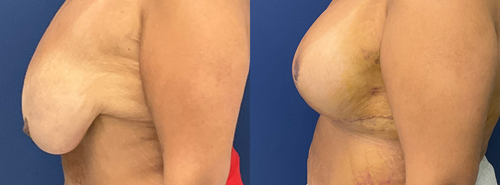 Breast Reduction Before and After