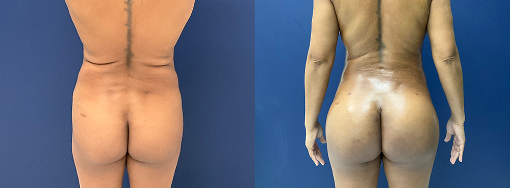 Brazilian Butt Lift Before and After