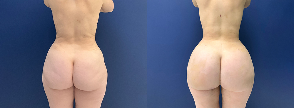 Brazilian Butt Lift Before and After