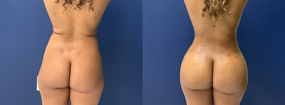 Brazilian Butt Lift Before and After in miami