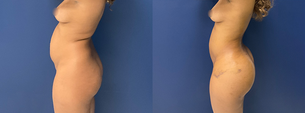 Brazilian Butt Lift Before and After in miami