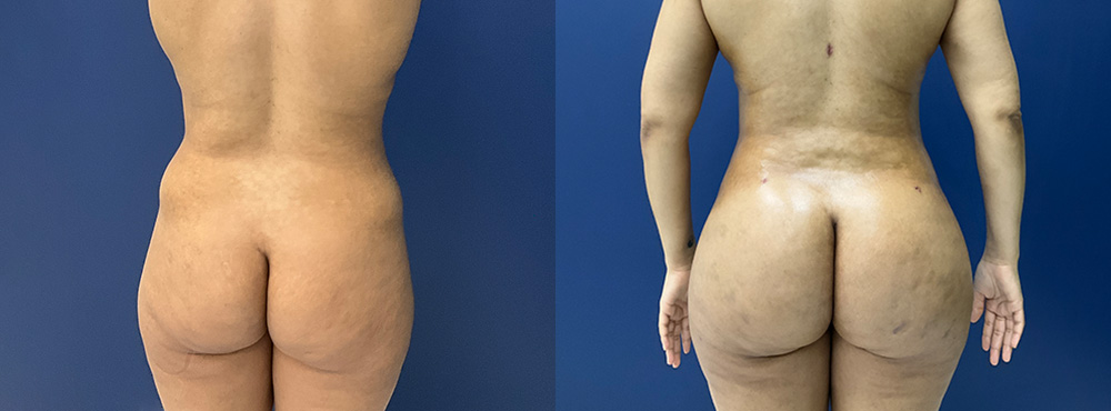Brazilian Butt Lift Before and After in Miami