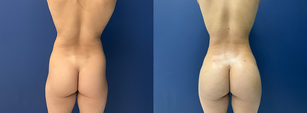 Brazilian Butt Lift Before and After