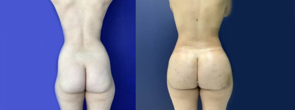 Brazilian Butt Lift Before and After in Miami