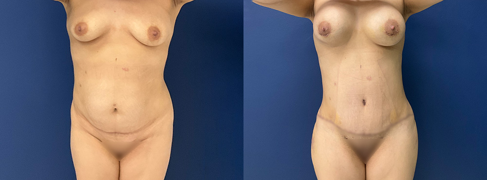 Mommy Makeover Before and After in Miami