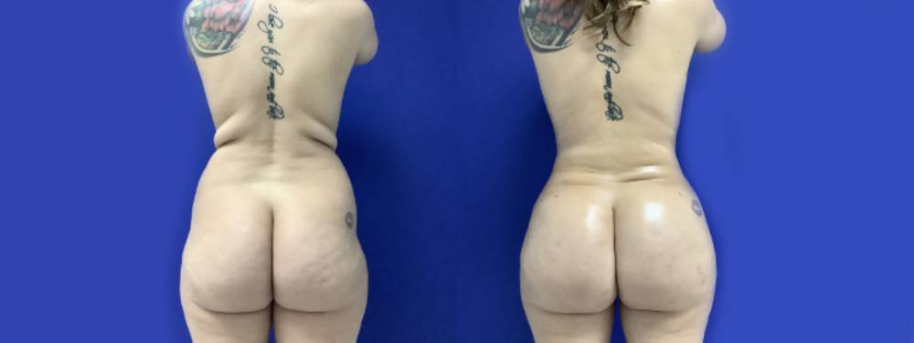 Brazilian Butt Lift Before and After in Miami