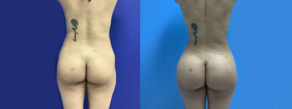 Brazilian Butt Lift Before and After 
