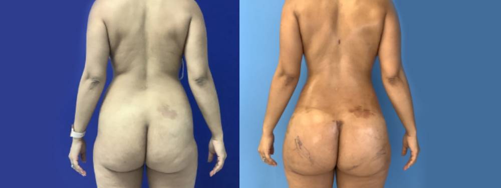 Brazilian Butt Lift Before and After in Miami