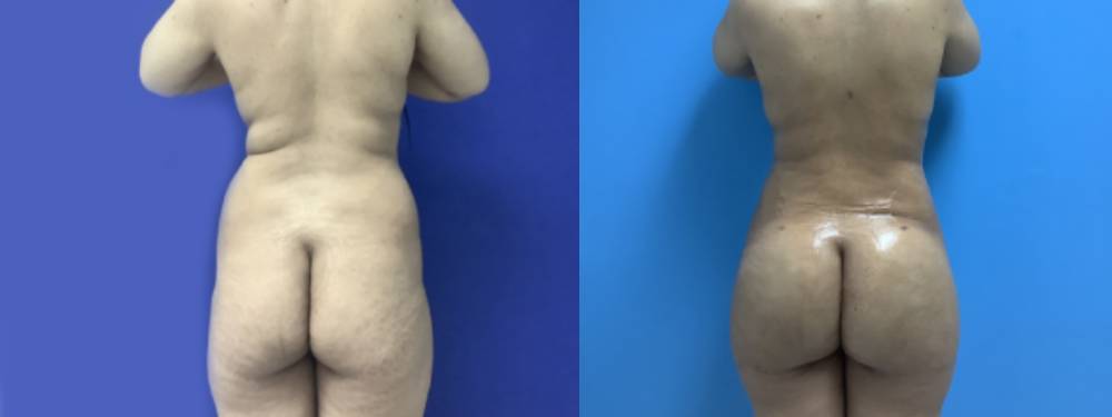 Brazilian Butt Lift Before and After 