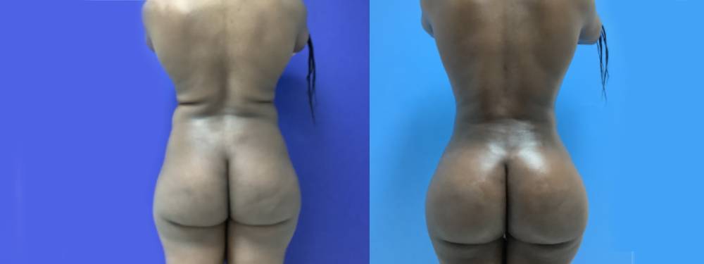 Brazilian Butt Lift Before and After in Miami