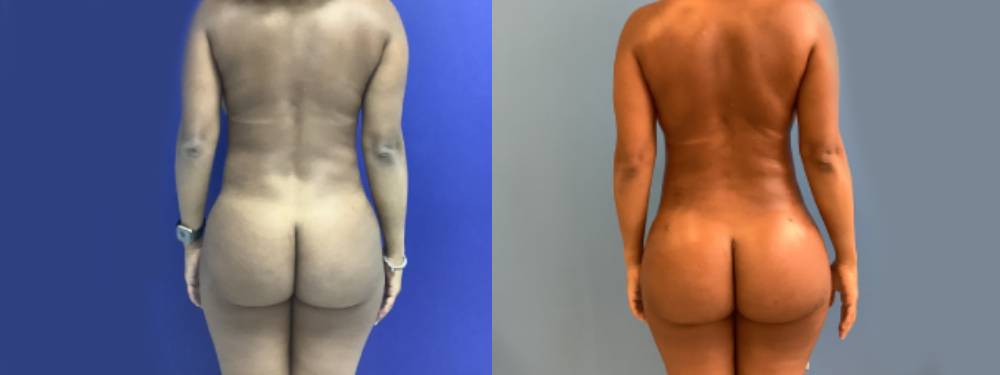 Brazilian Butt Lift Before and After 