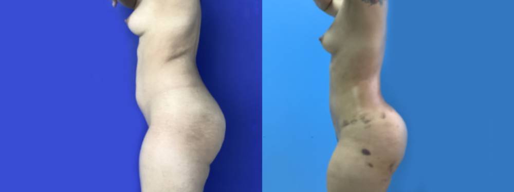Brazilian Butt Lift Before and After in Miami