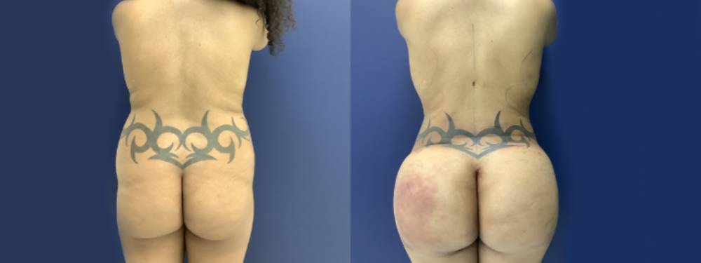 Brazilian Butt Lift Before and After in Miami