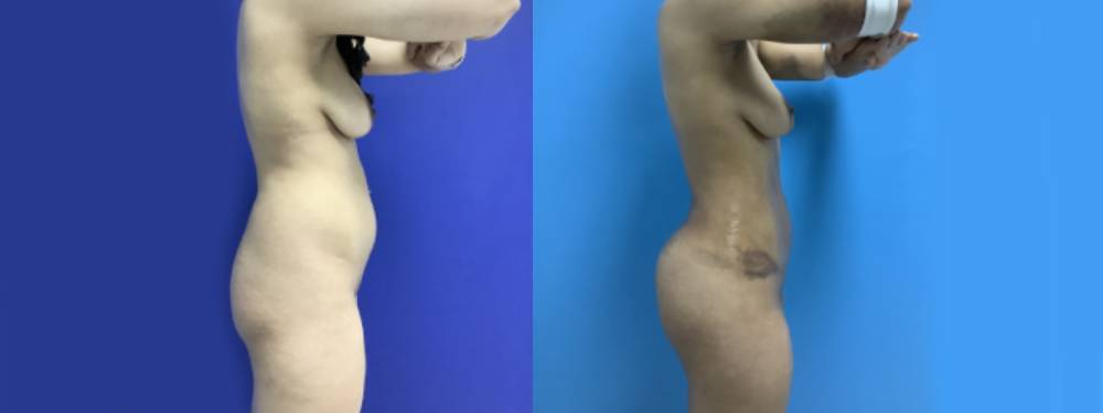 Brazilian Butt Lift Before and After in Miami