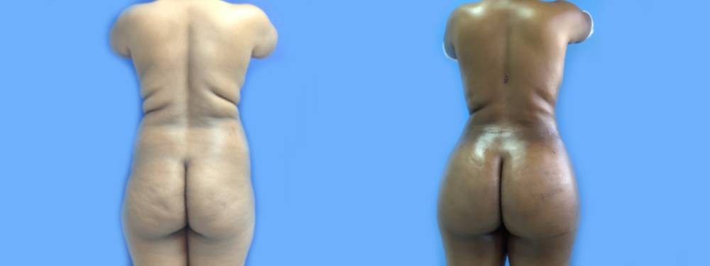 Brazilian Butt Lift Before and After in Miami 