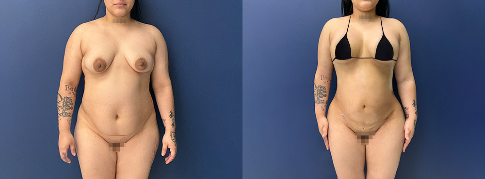 Combo Lipo 360 with Breast Lift