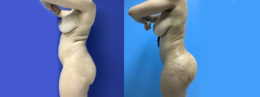 Brazilian Butt Lift Before and After 