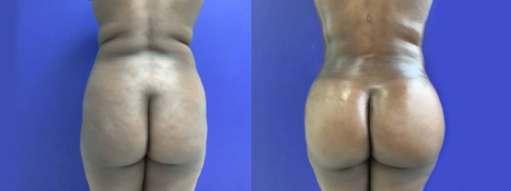 Brazilian Butt Lift Before and After in Miami