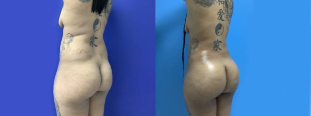 Brazilian Butt Lift Before and After in Miami