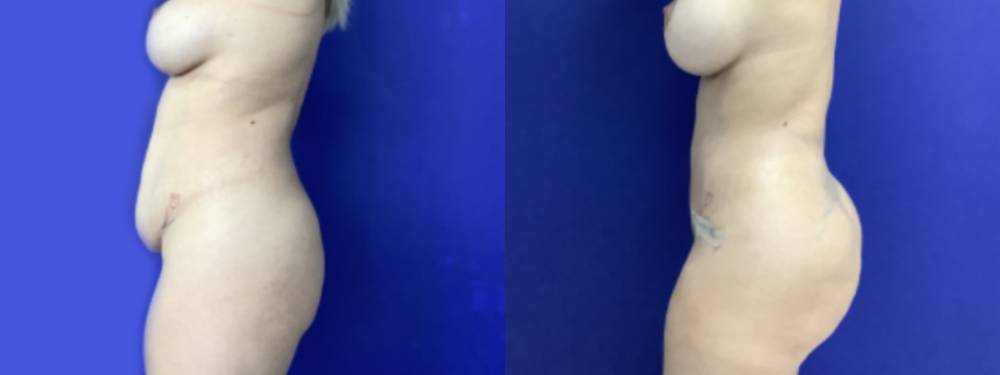 Brazilian Butt Lift Before and After