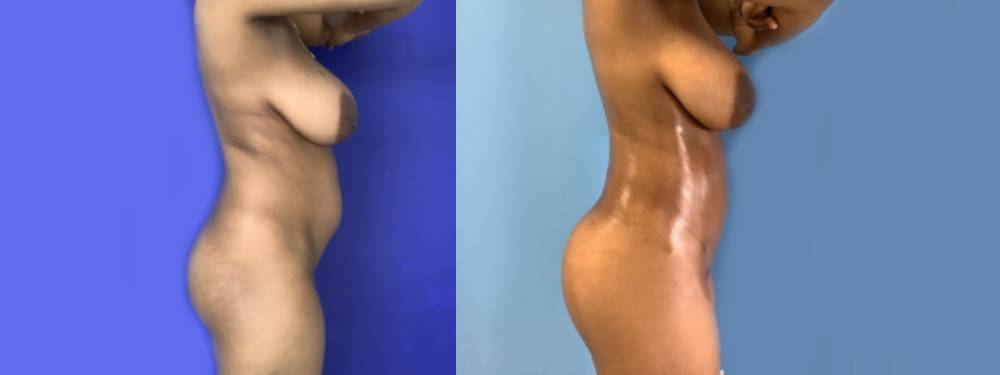 Brazilian Butt Lift Before and After 