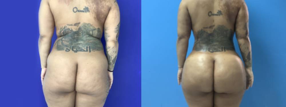 Brazilian Butt Lift Before and After
