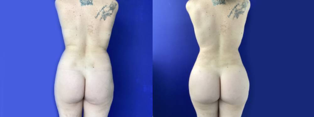 Brazilian Butt Lift Before and After in Miami