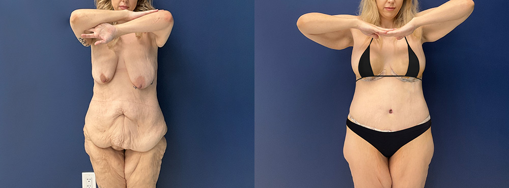 Mommy Makeover Results