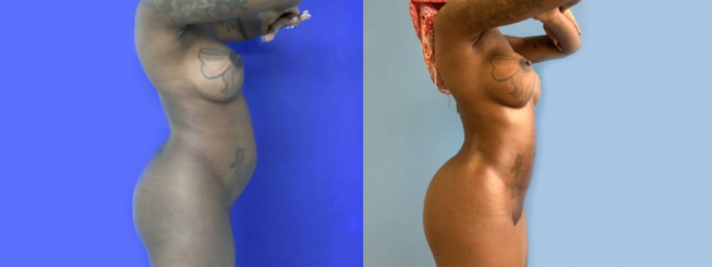 Brazilian Butt Lift Before and After 