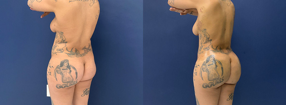 Brazilian Butt Lift Results fotos