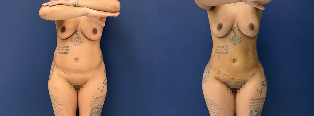 Brazilian Butt Lift Results fotos