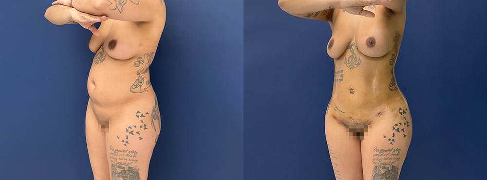 Brazilian Butt Lift Results fotos