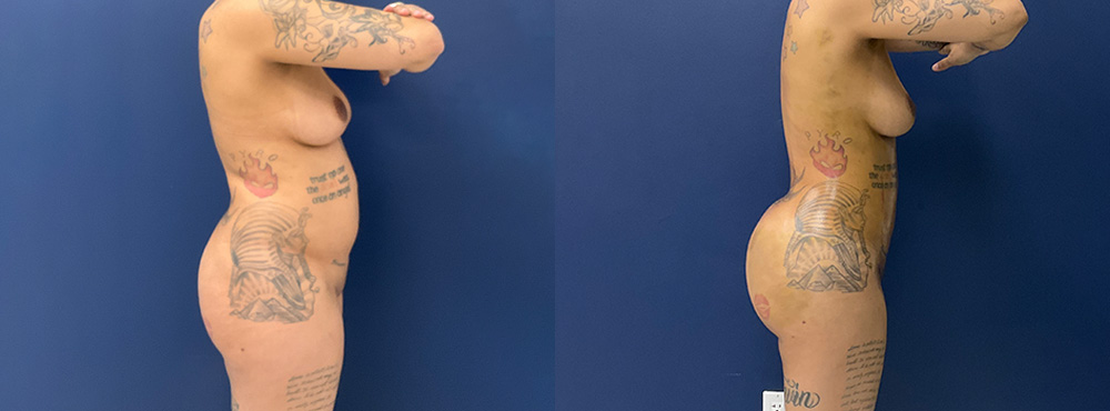 Brazilian Butt Lift Results fotos