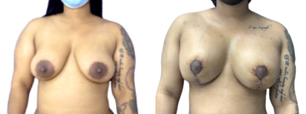 Breast Augmentation Before and After in Miami