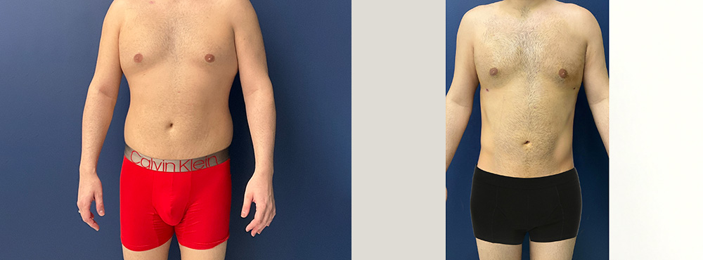 Male Liposuction before and after photos