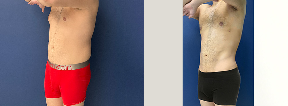 Male Liposuction before and after photos