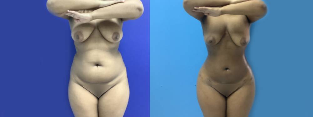 Liposuction Before and After in Miami