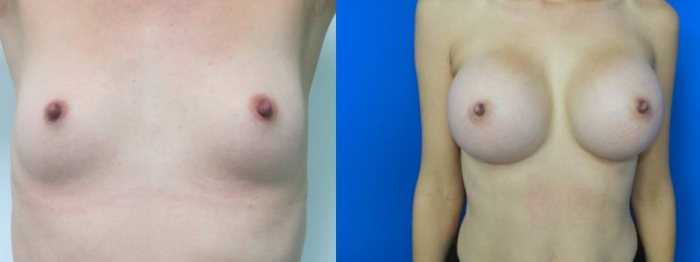 Breast Augmentation Before and After in Miami