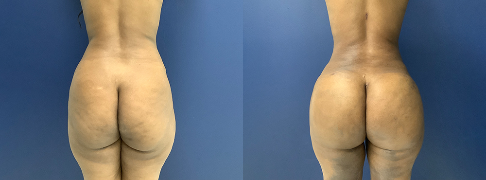 Brazilian Butt Lift Before and After