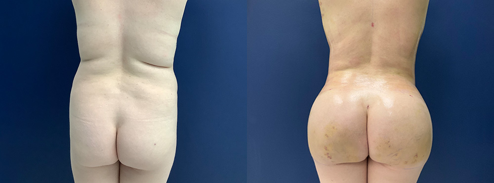 Brazilian Butt Lift before and after