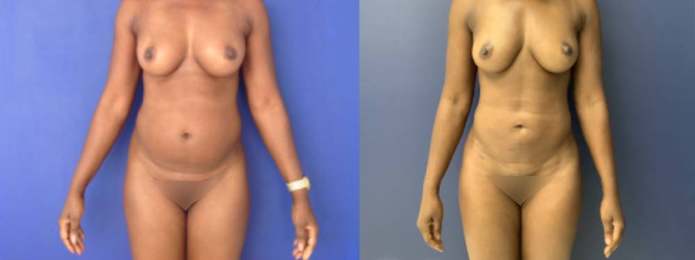 Liposuction Before and After in Miami