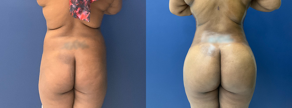 brazilian butt lift before and After in miami