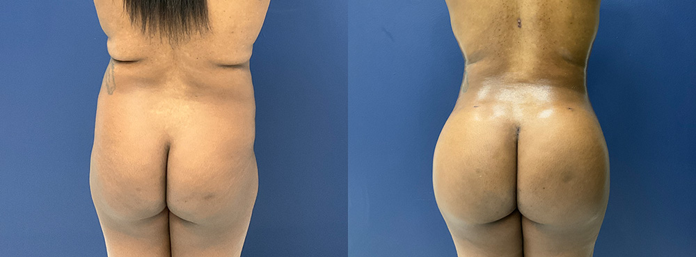 Brazilian Butt Lift Before and After in miami