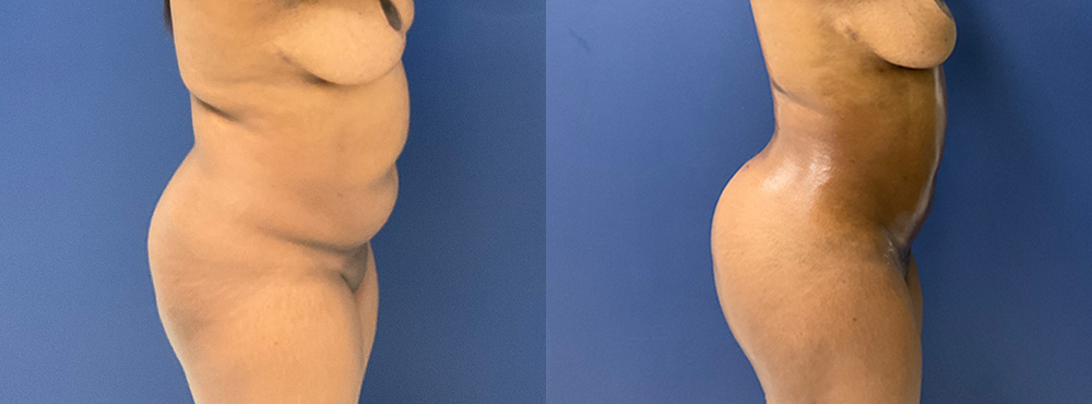 Brazilian Butt Lift Before and After in miami