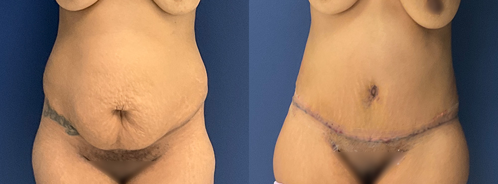 Tummy Tuck Before and After 