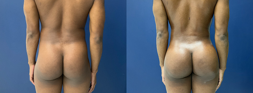 Male Brazilian Butt Lift Before and After