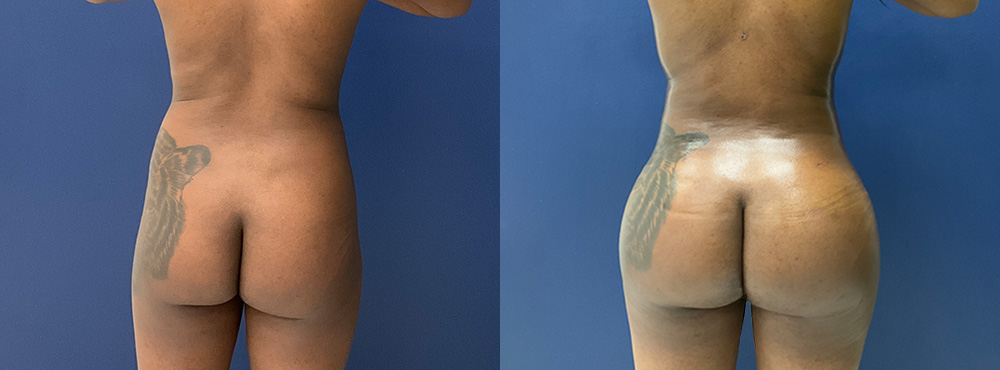 Brazilian Butt Lift Before and After