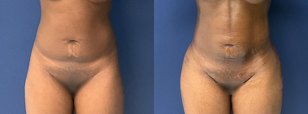 Brazilian Butt Lift Before and After