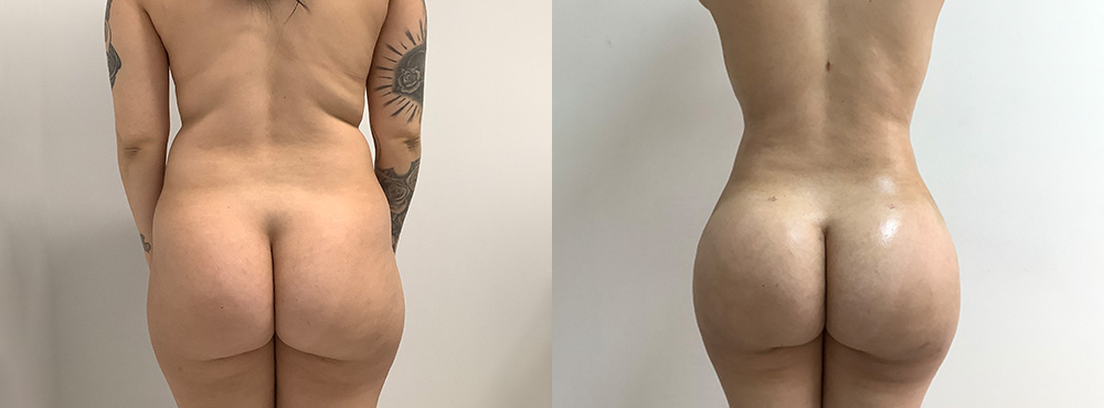 Brazilian Butt Lift Before and After in Miami